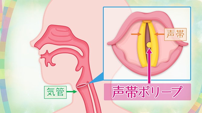 声帯ポリープの手術の噂は？